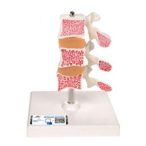 Deluxe Human Osteoporosis Model (3 Vertebrae with Discs ), Removable on Stand - 3B Smart Anatomy