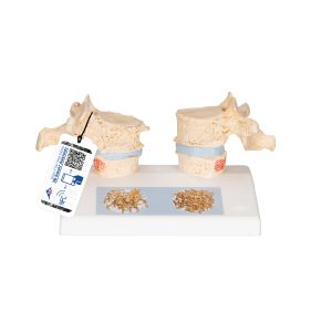 Model dydaktyczny osteoporozy - 3B Smart Anatomy