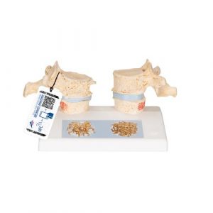 Osteoporosis Didactic Model - 3B Smart Anatomy