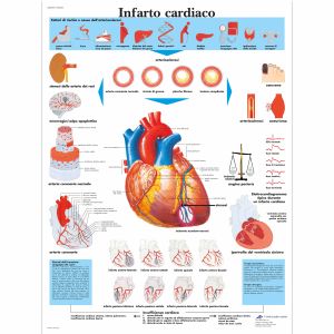 Infarto cardiaco